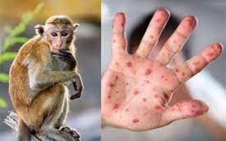 شناسایی ۹ بیمار مشکوک به آبله میمونی در ایران