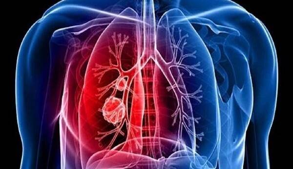 راه‌هایی برای مبارزه با برگشت سرطان ریه