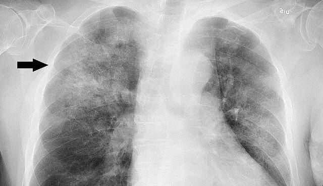 هشدار درباره یک بیماری حاد تنفسی در سرما