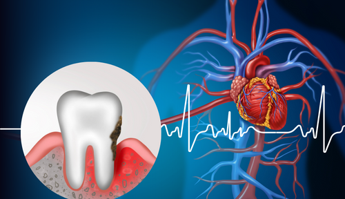 عفونت لثه، یک عامل خطر جدید برای آریتمی قلبی