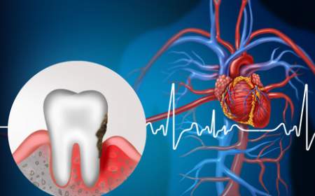 عفونت لثه، یک عامل خطر جدید برای آریتمی قلبی