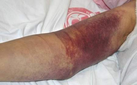 شناسایی ۱۸ بیمار مبتلا به تب کریمه کنگو در ایران
