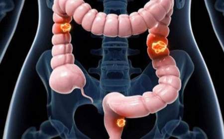 سرطان روده، مهم‌ترین عامل مرگ و میر افراد بالای ۵۰ سال است