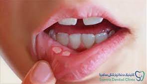 مصرف این غذاها باعث آفت زبان و گلو می شوند