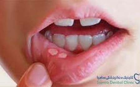 مصرف این غذاها باعث آفت زبان و گلو می شوند