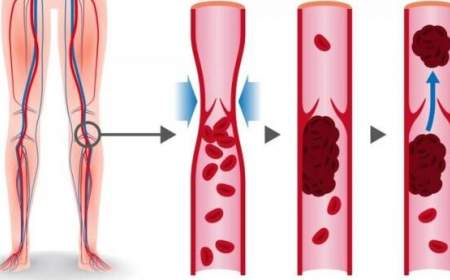خطرات لخته خون در پا، علائم و راه‌های پیشگیری