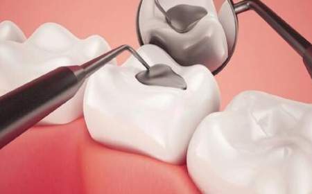 مایع ارزان‌قیمتی که دندان‌ها را «ضد پوسیدگی» می‌کند
