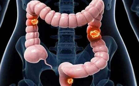 افزایش شدید موارد سرطان روده بزرگ در کودکان و نوجوانان